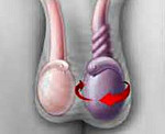 Перекручивание яичка у мальчиков 13