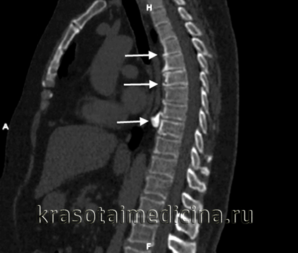 КТ грудного отдела позвоночника. Множественные краевые костные разрастания передних отделов тел позвонков (деформирующий грудной спондилез)