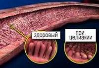Целиакия