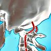 Синдром позвоночных артерий операция цена thumbnail