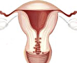Эндометриоз шейки матки
