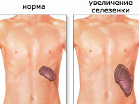 Температура при воспалении селезенки thumbnail