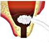 Остеопластика лунки зуба