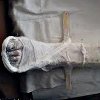 Наложение деротационного сапожка