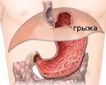 Грыжа пищеводного отверстия диафрагмы