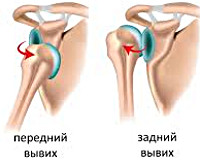 Изображение - Иммобилизация при вывихе плечевого сустава 8d91c92fda60ff037f82c74b0a4afcb9