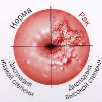 Анализ мочи на онкопротеины поможет диагностировать РШМ