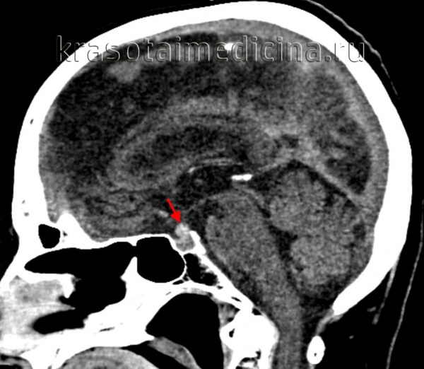 КТ головного мозга. Объемное образование (аденома) гипофиза.