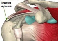 Тендовагинит плечевого сустава симптомы лечение