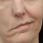 Асимметрия носогубных складок Асимметрия носогубных складок
