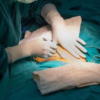 Оперативное родоразрешение повышает риск рака крови у детей