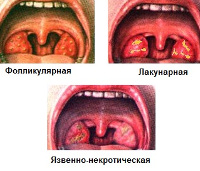 Ангина при лейкозе