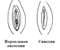 Почему у девочек срастаются малые губы 41