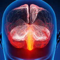 Мигрень с аурой связана с развитием ишемического инсульта