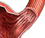 Синдром Меллори-Вейса
