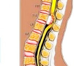 Спинальная менингиома