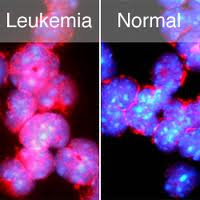 Генетическая мутация стволовых клеток вызывает заболевания крови
