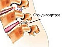 Поясничный спондилоартроз