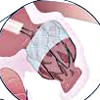 Эндоваскулярная окклюзия ушка левого предсердия