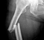 Перелом бедренной кости у детей. Перелом бедренной кости у детей: особенности травмы, причины, классификация, симптомы и прогноз