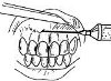 Анестезия инфильтрационная в стоматологии