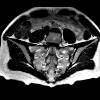 МРТ крестцово-подвздошных сочленений