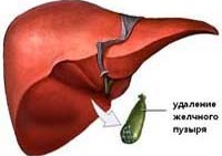Реферат: Постхолецистэктомический синдром
