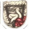 Ликвидация кишечной непроходимости