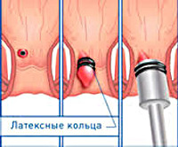 Процедура Латексное лигирование геморроидального узла