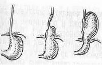 Грыжа пищеводного отверстия диафрагмы