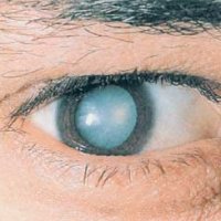 Слепота при глаукоме вызвана аутоиммунным ответом