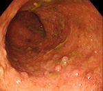Псевдополипоз ободочной кишки