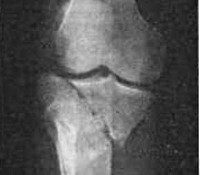 Перелом мыщелков большеберцовой кости