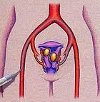 Эмболизация маточных артерий при миоме