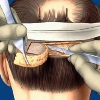 Пересадка волос стрип-методом (1 графт)