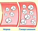 Панкреатогенный сахарный диабет