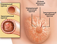 Эктазия молочных протоков что это 9