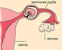 Трубная беременность