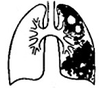 Казеозная пневмония