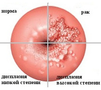 Реферат: Методы лечения доброкачественных и предраковых заболеваний шейки матки