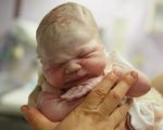 Родовая опухоль Родовая опухоль