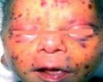 Цитомегаловирусная инфекция у детей
