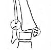 Репозиция лодыжкек при двухлодыжечном переломе