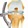 Артроскопический артролиз коленного сустава