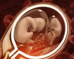 Синдром исчезнувшего близнеца