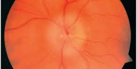 Ишемическая нейропатия зрительного нерва