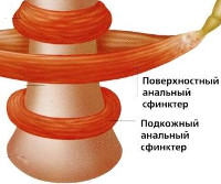 Спазм анального сфинктера