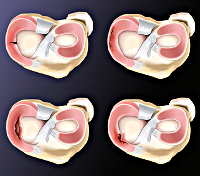 Лечение разрыва мениска коленного сустава