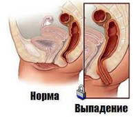 Запор у ребенка кишки наружу thumbnail