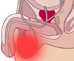 Абсцесс мошонки